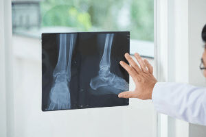 FDA Warns of Significant Defect with STAR Ankle Implant