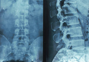 spinal cord injury overview