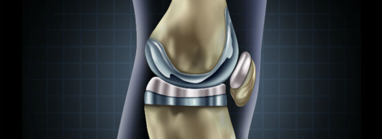 knee replacement implant 